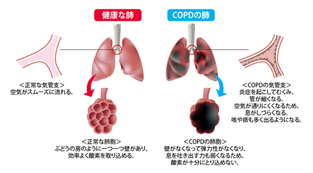 側頭葉てんかんは年齢とともに悪化しますか？