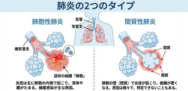 肺炎の2つのタイプを表した図解