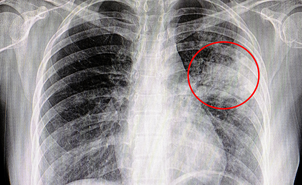 子供の肺炎はどのように診断されますか?