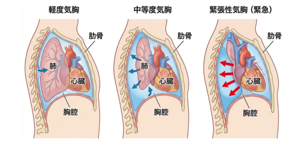 気胸の図解