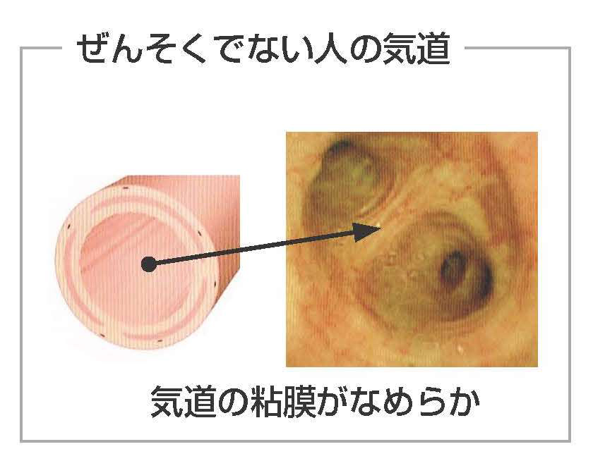 気管痛い痰, 日常的に痰が絡む | Q6 黄色または緑色のたんが出ます – RMHF